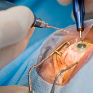 Eye surgery