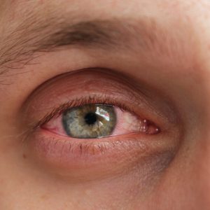 red eye of a patient with human conjunctivitis